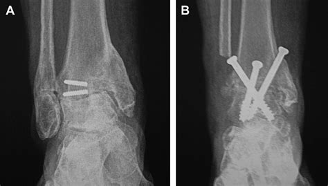 Ankle Arthrodesis: The Simple and the Complex - Foot and Ankle Clinics