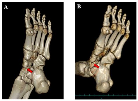 Roentgen Ray Reader Types Of Accessory Navicular Bones