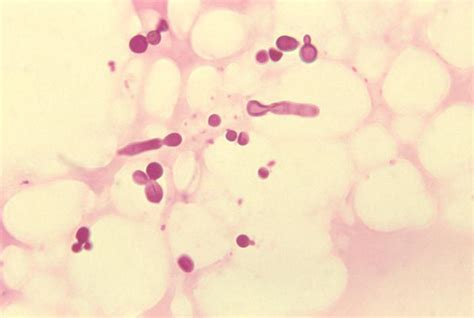 Malassezia - Wikipedia