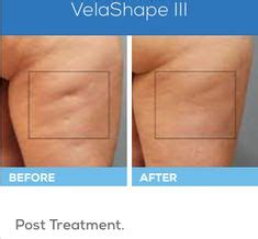 1000+ images about VelaShape - Before and After on Pinterest | Medical ...