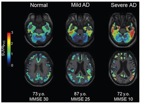 Biomolecules | Special Issue : Tau Protein and Alzheimer’s disease