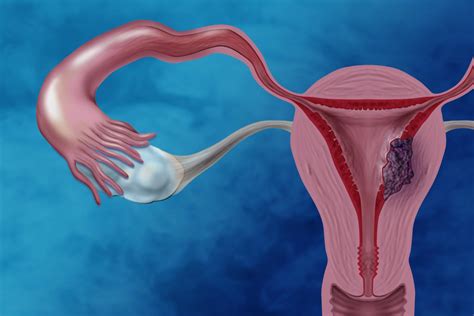 First-Ever Comprehensive Study on the Endometrial Cancer - TheHealthMania