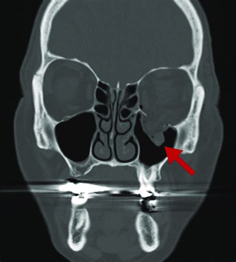 Orbital Floor Fracture Healing Time Without Surgery | Floor Roma