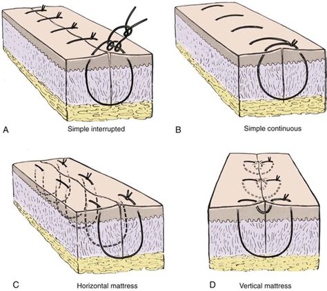 Best Mattresses of 2020 | Updated 2020 Reviews‎: Buried Vertical Mattress Suture