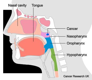 TNM stages of nasopharyngeal cancer | Cancer Research UK