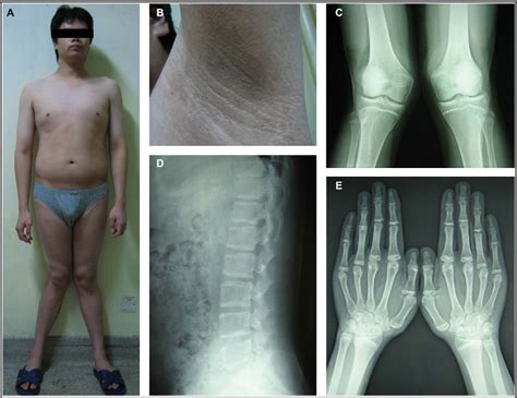 Aromatase deficiency in a Chinese adult man caused by novel compound ...