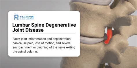 Lumbar Spine Degenerative Joint Disease Treatment in New Jersey