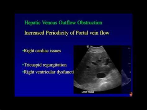 Portal Vein Ultrasound