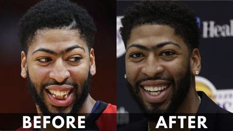 Anthony Davis Teeth Transformation 2022: Before & After – Reduce Fat