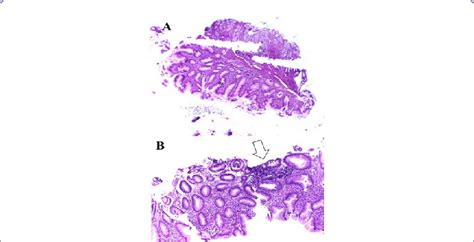 Microscopic field of antral gastric mucosa with a diagnosis of chronic... | Download Scientific ...