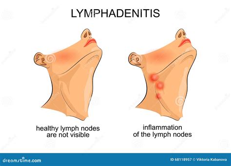 Lymphadenitis . Inflammation Of The Lymph Nodes Stock Photo - Image ...