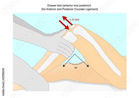 30+ Knee Posterior Drawer Test - KatrynCheryl