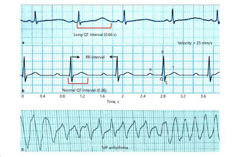 Normal Ecg Trace