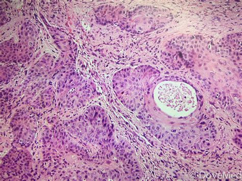 Squamous Cell Carcinoma Mouth