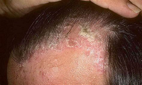 Scalp psoriasis images | Symptoms and pictures