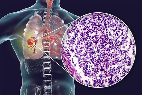 Novel Target Protein Discovered to Treat Small Cell Lung Cancer | Oncotarget