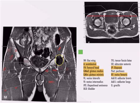 DXI 2-10: pelvis and hip, coronal MRI 3 Diagram | Quizlet