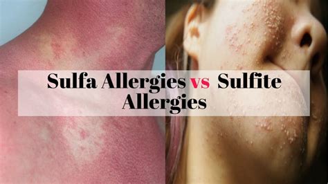 What is a Real Sulfa Drug Allergic Reaction?