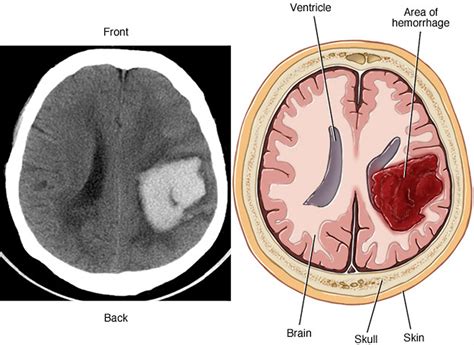 Venous Hemorrhage