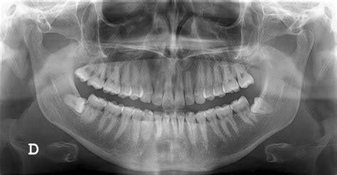 Importance of Dental Radiographs, Types and Uses - Pediatric Dentist in ...