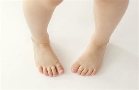 My Child is Pigeon-toed what should I do?