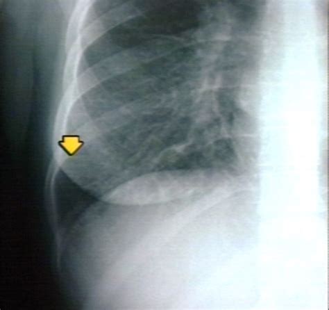 Congestive heart failure chest x ray - wikidoc