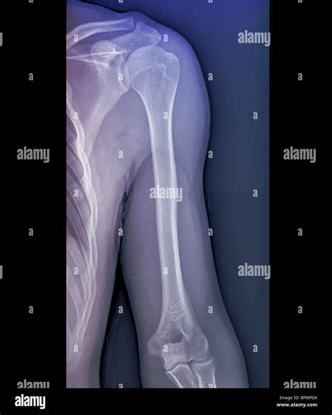 Normal shoulder joint, X-ray Stock Photo - Alamy