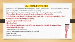 Varicose veins | PPT