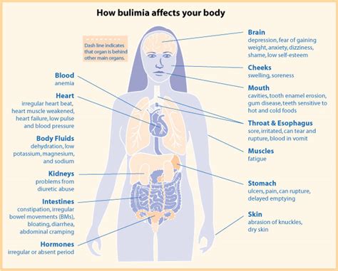 Bulimia Nervosa - Physiopedia