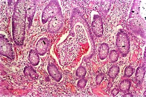 Colon tumor - Inflammatory polyp of colon