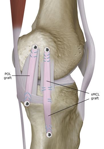 Surgical Techniques for the Reconstruction of Medial Collateral ...