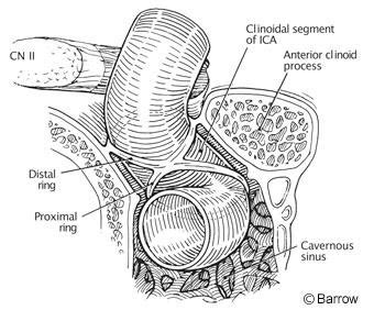 Microsurgical Anatomy of the Clinoidal Segment of the Internal Carotid ...