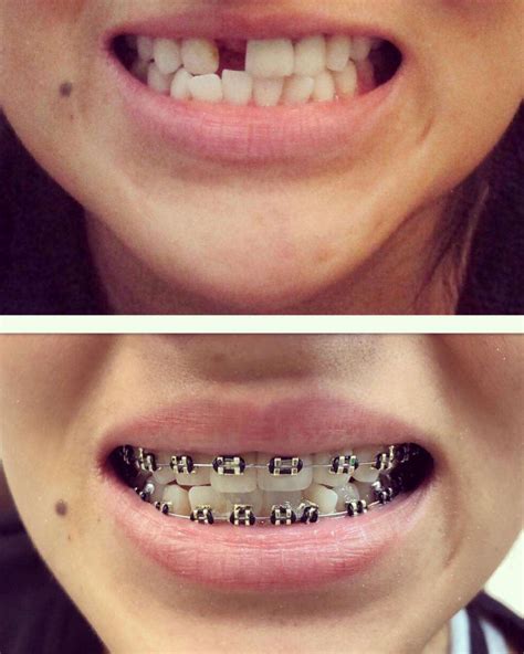 Orthodontist in Tustin, CA - Smile Gallery FitSmiles Orthodontics | Before & After