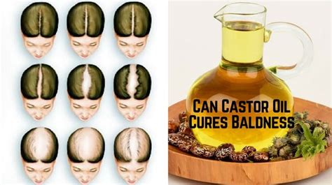 Can Castor Oil Cures Baldness?