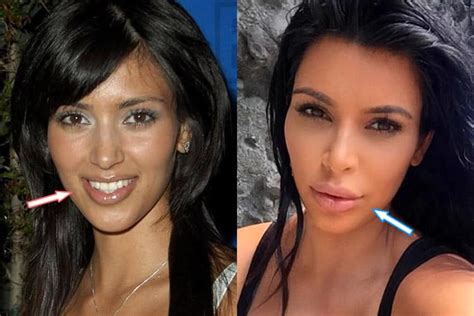 Kim Kardashian Plastic Surgery REVEALED! (Before & After Pics 2018)