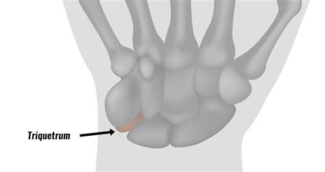 Triquetrum Fracture - Symptoms, Causes & Treatment.