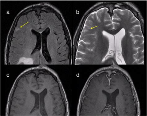 Cortical T2-hyperintense lesion suggestive of cortical dysplasia in a... | Download Scientific ...