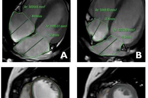 Imaging the adolescent heart provides 'normal' reference values for clinical practice