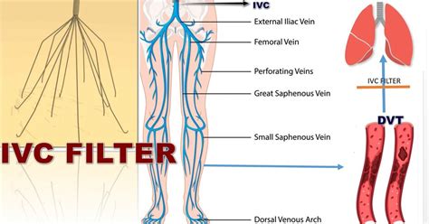 IVC FILTER SURGERY IN INDIA - Dr. Malleswara Rao