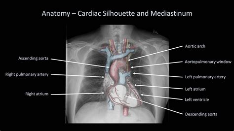 How to Interpret a Chest X-Ray (Lesson 2 - A Systematic Method and ...