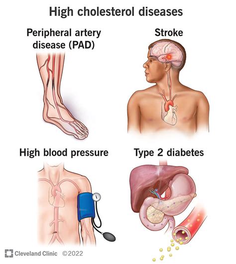 Causes of high cholesterol