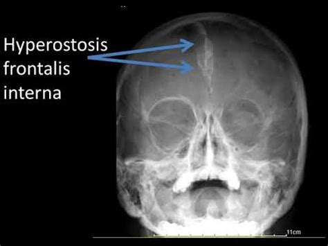 CASE 387 SKULL Hyperostosis frontalis interna - YouTube