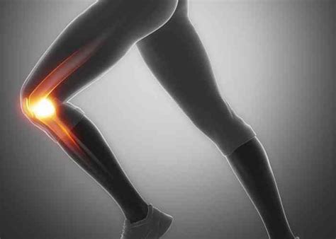 Medial Patellofemoral Ligament Reconstruction | MPFL Injury | Sugar ...