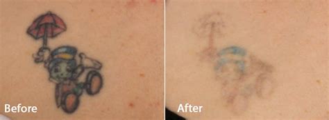 PicoWay Laser | Tattoo Removal | All Colors No Problem