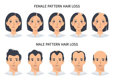 Hair loss stages, androgenetic alopecia male and female pattern. Steps ...