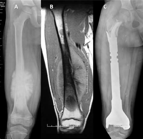 A: Preoperative xray of a distal femur osteosarcoma. B: The MRI shows ...