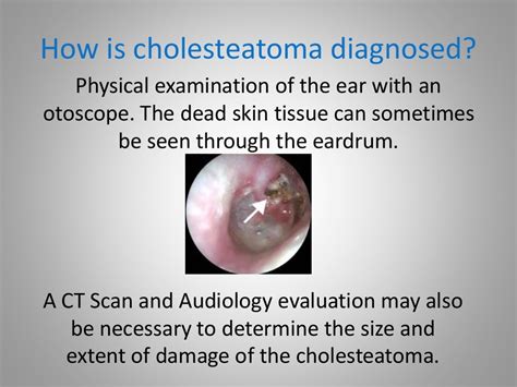 What is Cholesteatoma?