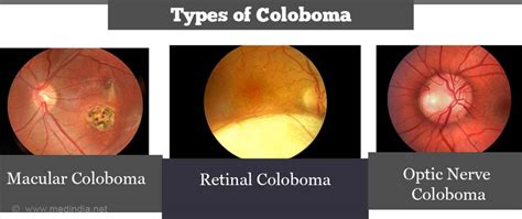 Coloboma - Causes, Symptoms, Diagnosis, Treatment & Prevention