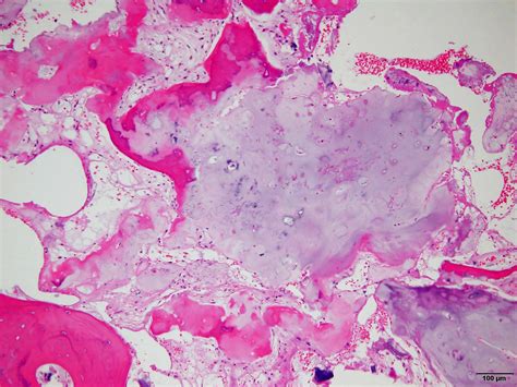 Multiple Enchondromatosis Histology