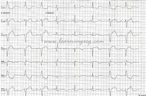 ECG Rhythms: Is this third degree AV block or NOT?